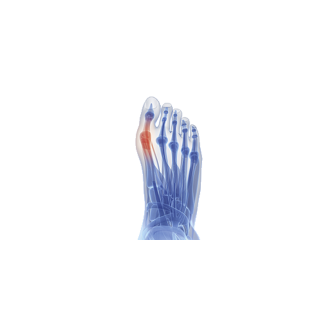 Hallux Valgus